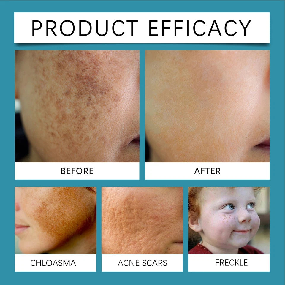 Non Invasive Mole and Wart Removal Pen